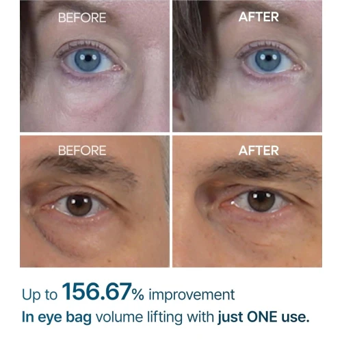 [Cuidado de día y de noche] Línea para levantar bolsas de los ojos Eyephalt - Image 18